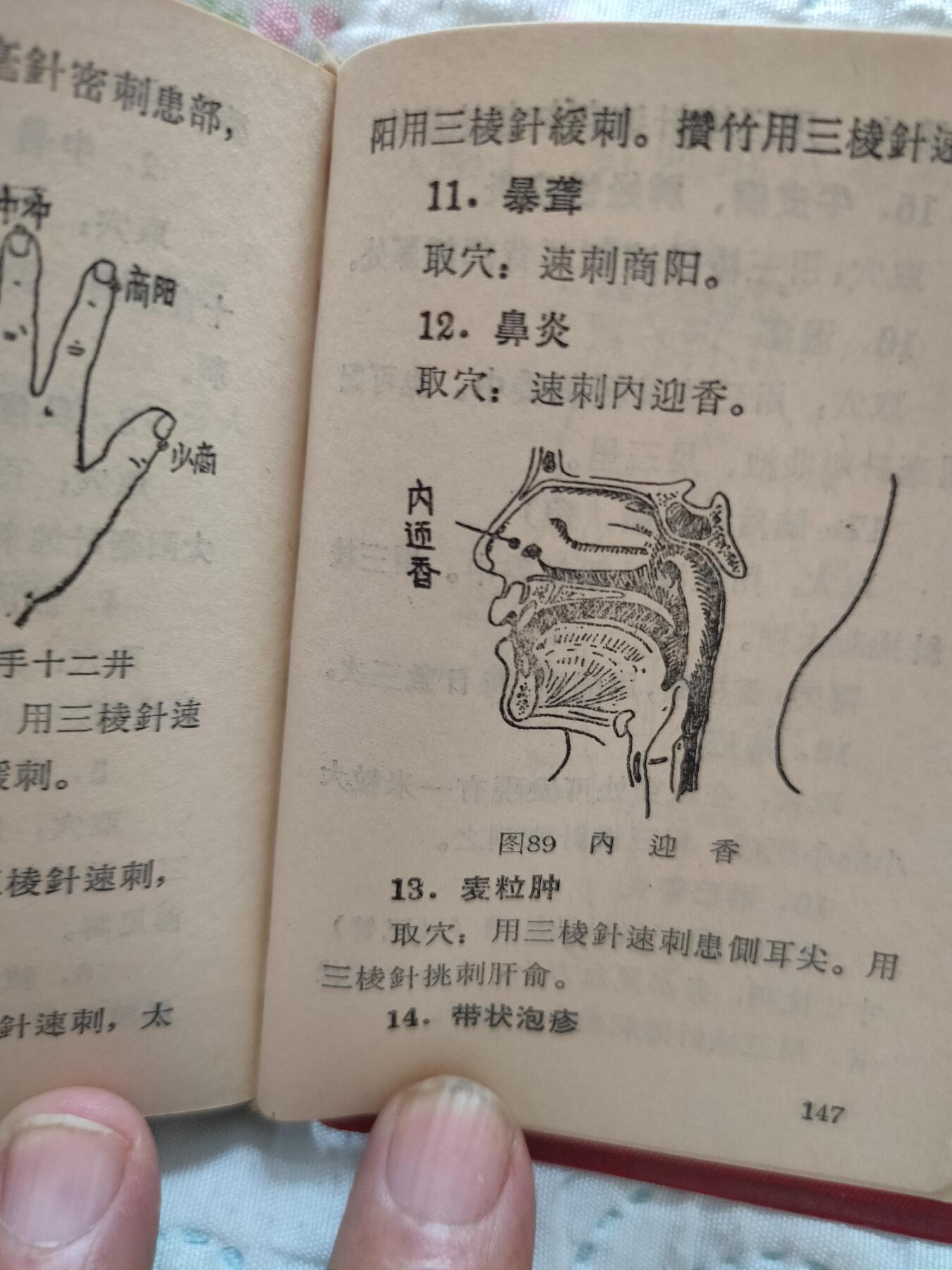 沈阳医学院1969年新针疗法，扎干针