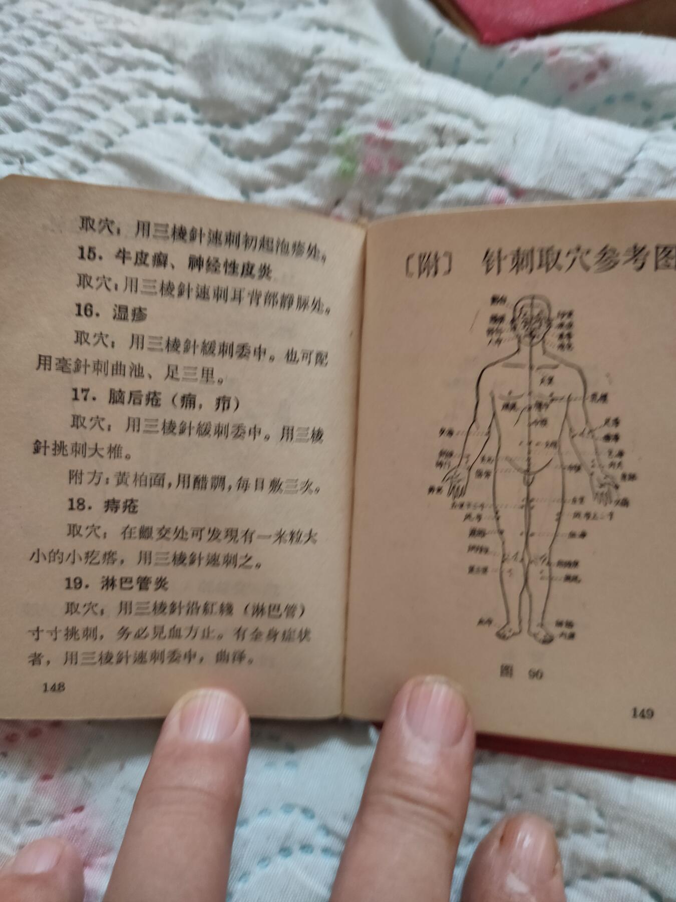 沈阳医学院1969年新针疗法，扎干针